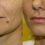 How-to-Get-Rid-of-Moles-Without-Surgery_mini