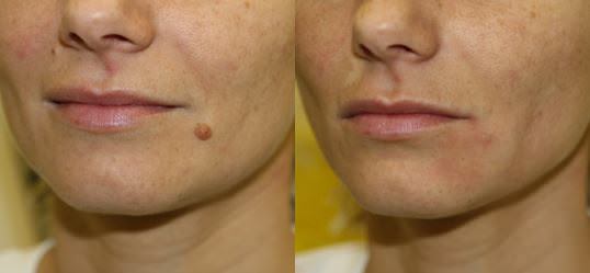 How-to-Get-Rid-of-Moles-Without-Surgery_mini