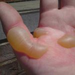 How to Get Rid of Sunburn Blisters