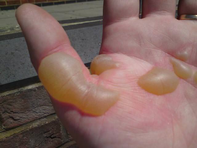 How to Get Rid of Sunburn Blisters