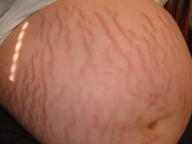 How to Prevent Stretch Marks in Pregnancy