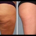 How to Get Rid of Cellulite on Legs