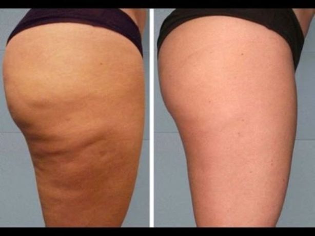 How to Get Rid of Cellulite on Legs