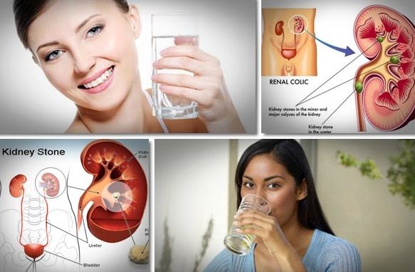 How to get rid of kidney stones fast and naturally