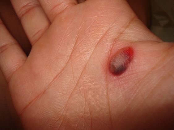 How to treat a blood blister