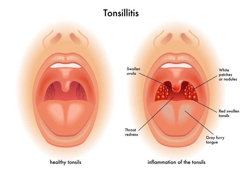 How to treat tonsillitis