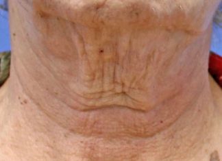 How to Prevent Neck Wrinkles?