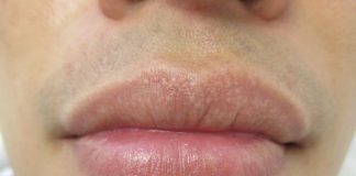 Tips to Prevent and Treat Fordyce Spots on Lips