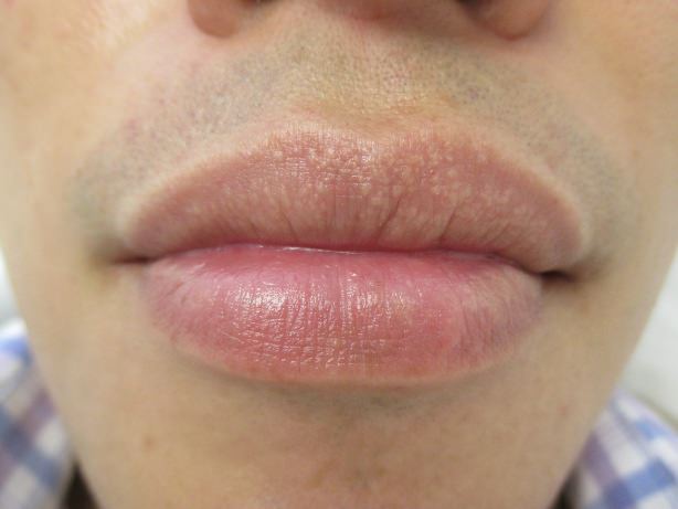 Tips to Prevent and Treat Fordyce Spots on Lips 