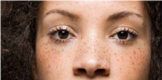 How to Get Rid of Freckles?