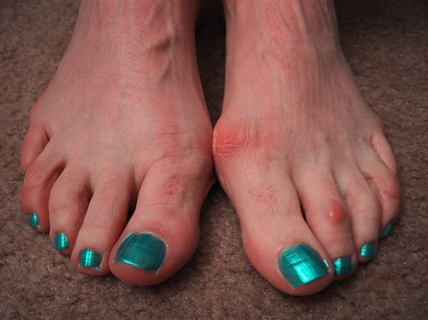 How to get rid of Bunions?