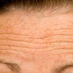 Ways to Get Rid of Forehead Wrinkles at Home