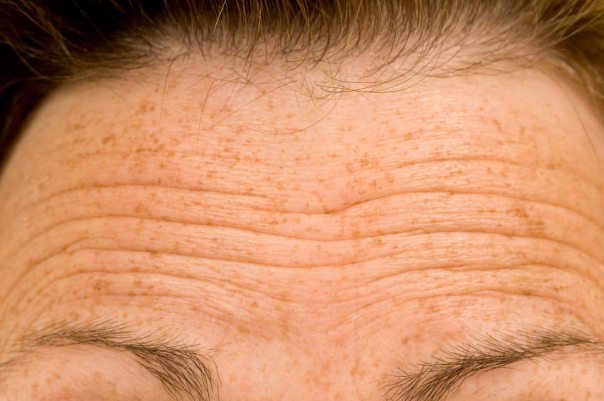 Ways to Get Rid of Forehead Wrinkles at Home