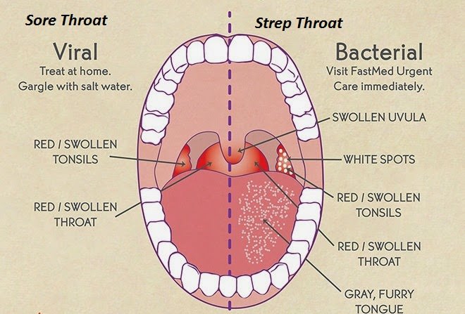 How to Get Rid of Strep Throat?