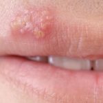 home remedies for fever blister