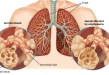 home remedies to treat emphysema