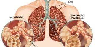 home remedies to treat emphysema