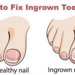 how to cure an ingrown toenail – get rid of ingrown toenail
