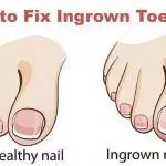 how to cure an ingrown toenail - get rid of ingrown toenail