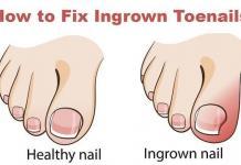 how to cure an ingrown toenail - get rid of ingrown toenail
