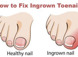 how to cure an ingrown toenail - get rid of ingrown toenail