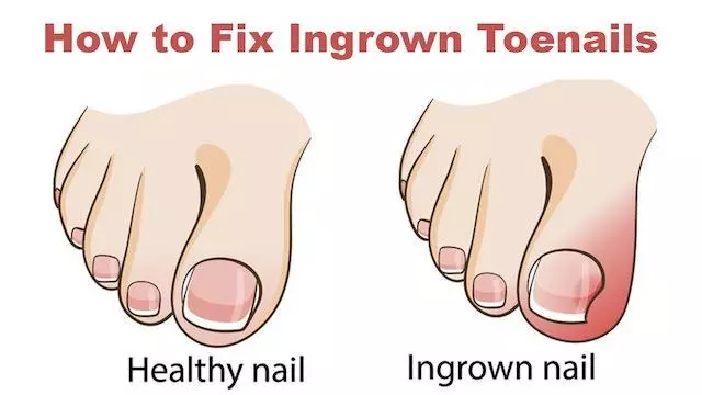 Home remedies for ingrown toenails
