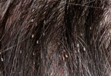 how to detect lice
