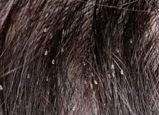 how to detect lice