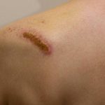 how to get rid of a scab