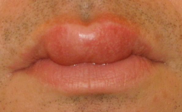 how to get rid of a swollen lip fast