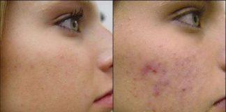 how to get rid of cystic acne
