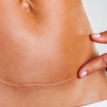 how to get rid of keloid scars