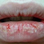 how to get rid of painful cracked lips