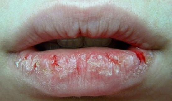 how to get rid of painful cracked lips