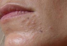 how to get rid of sebaceous hyperplasia