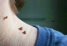 how to get rid of skin tags naturally and fast