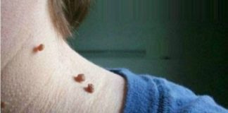 how to get rid of skin tags naturally and fast