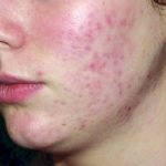 how to make your own acne treatment