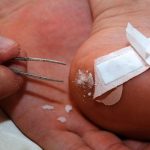 how to remove a splinter with baking soda