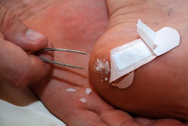 how to use baking soda for splinter removal