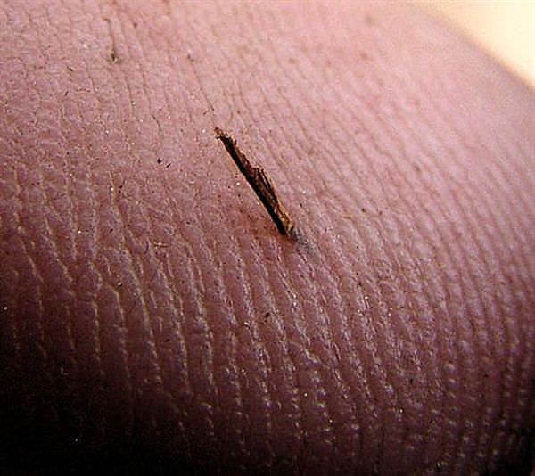 how to get a splinter out - remove a splinter