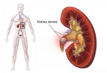 Home Remedies to Flush Out Kidney Stones