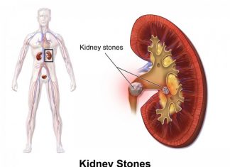 Home Remedies to Flush Out Kidney Stones