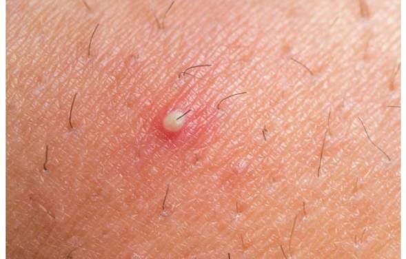 remove-redness-around-pimple-howrid-6522