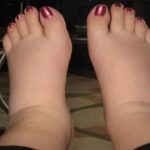  Home Remedies for Swollen Feet