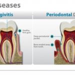treat gum disease with  home made remedies