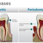 treat gum disease with  home made remedies