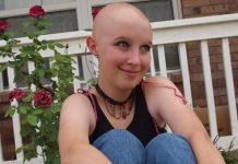 Alopecia Hair Loss Treatment