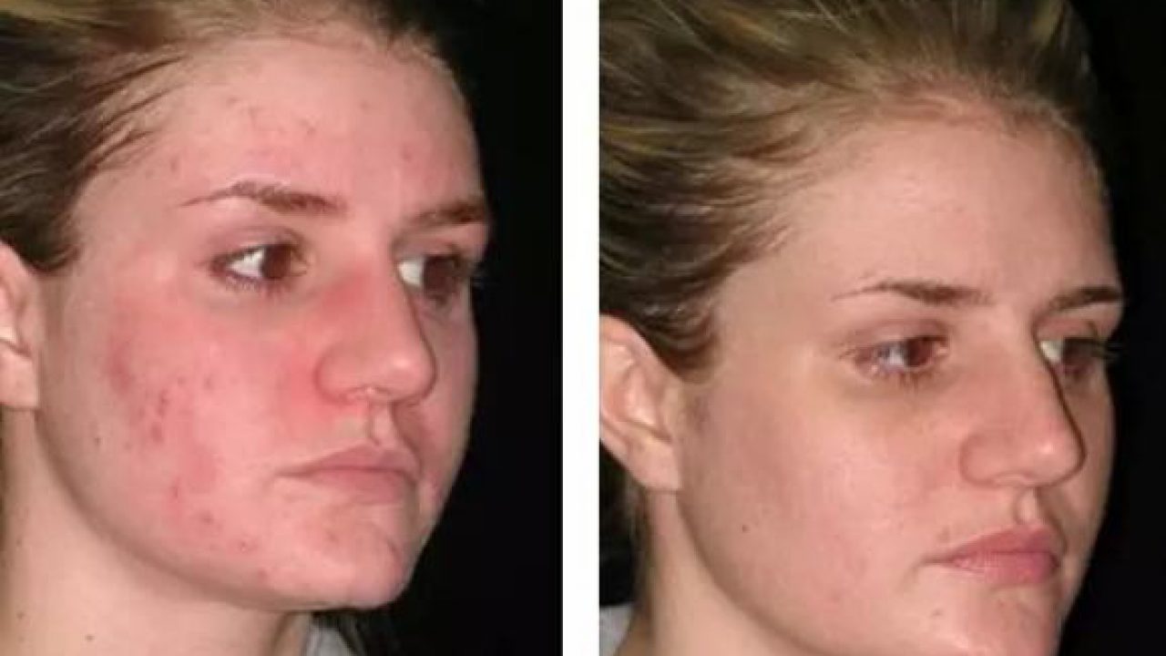 Treatment redness overnight acne 5 Overnight