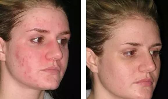 how to get rid of redness from acne and pimple